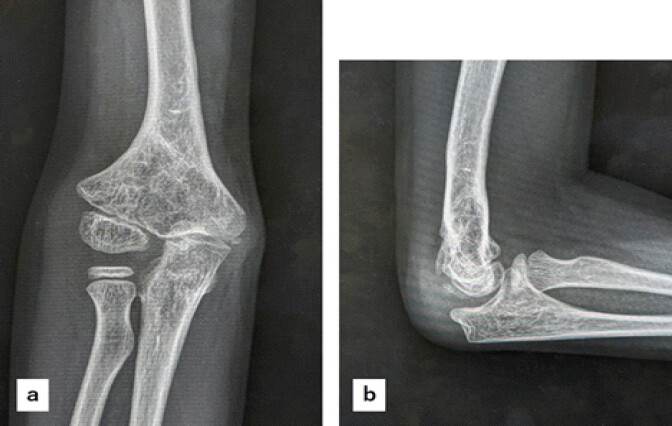 Figure 6: X-ray findings at final follows up. (a): Anteroposterior view, (b): Lateral view.