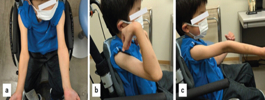 Figure 7: The patient’s appearance at final follows up. The carrying angle of the right elbow has improved to normal (a), and the range of motion for elbow flexion and extension is full (b and c).