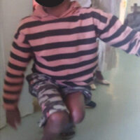 Figure 1: Pre-operative clinical photograph demonstrating the patient’s mobility mode, showing that due to the inability to walk upright and lack of walking aids, he was forced to crawl for mobility.