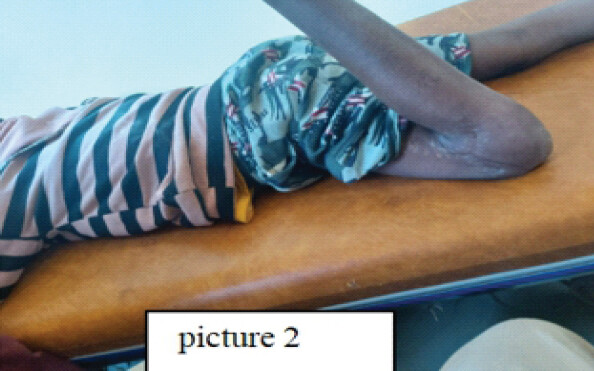Figure 2: Pre-operative clinical photograph demonstrating a fixed, severe left knee flexion contracture of 140° in a 14-year-old patient.