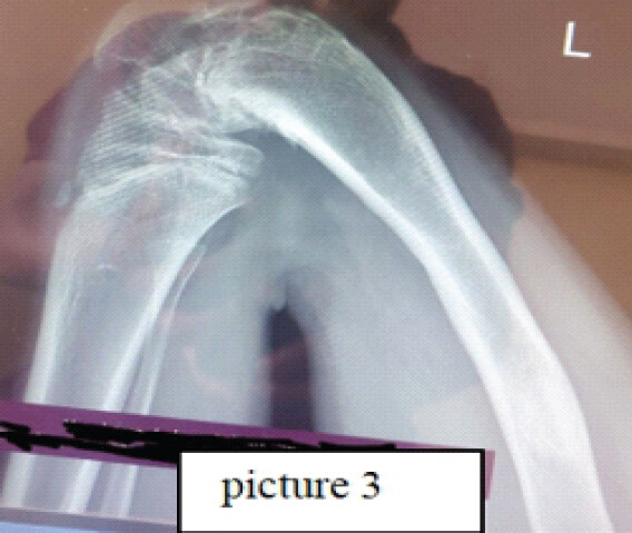 Figure 3: Pre-operative lateral radiograph of the left lower limb showing a severe fixed knee flexion deformity accompanied by significant apex-anterior distal femoral angular deformity.