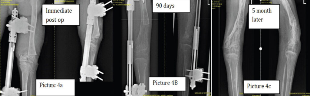 Figure 4: (a) (immediate post-operative AP and lateral radiographs): Post-operative radiographs demonstrating the distal femoral osteotomy site with compression achieved across the osteotomy planes. (b) (90-day post-operative): Radiographs demonstrating the distraction zone at approximately 90 days, showing progressive bone regeneration and adequate lengthening gap maintenance under external fixation. (c) (5 months later/consolidation phase): Follow-up radiographs showing substantial cortical maturation of the regenerated bone column following the completion of the distraction phase.