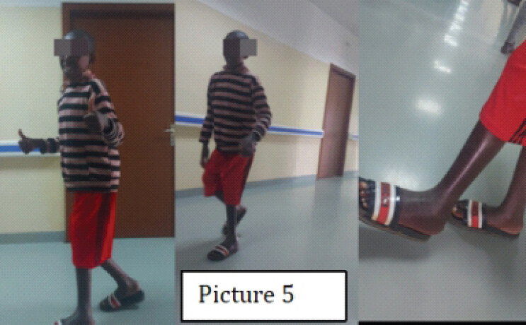Figure 5: (Clinical follow-up): Clinical photographs demonstrating the patient at final follow-up after adequate consolidation, showing independent, upright ambulation with a corrected, pain-free gait, and restored lower extremity alignment.