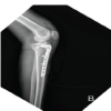 Triple Traumatic Fracture-Dislocation: A Rare Case of Simultaneous Ipsilateral Hip, Knee, and Ankle Fracture-Dislocation with a Review of the Literature