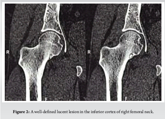 Osteoid Osteoma of the Femoral Neck Masquerading as Avascular Necrosis ...