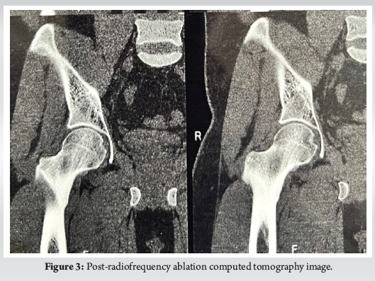 Osteoid Osteoma of the Femoral Neck Masquerading as Avascular Necrosis ...