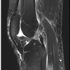 Inverted Cyclops Lesion Following Anterior Cruciate Ligament Repair: A Case Report