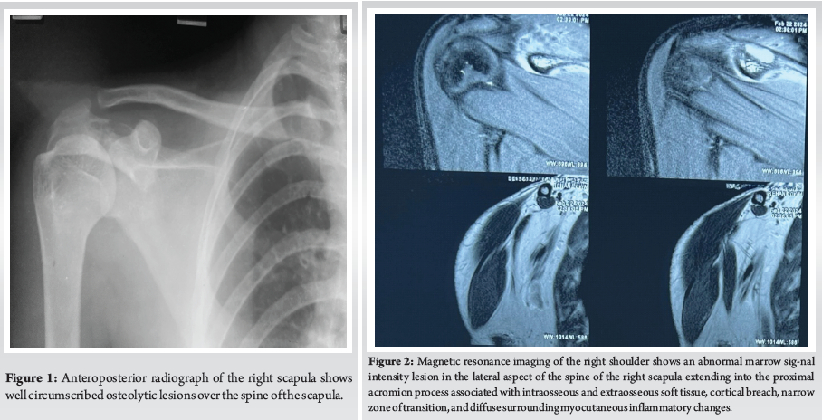Isolated Scapular Spine Involvement: A Rare Presentation of ...
