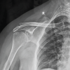 Isolated Scapular Spine Involvement: A Rare Presentation of Osteoarticular Tuberculosis
