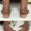 Complete Excision and Gastrosoleus Turn-Down Reconstruction for Achilles Tendon Xanthoma: A Case Report