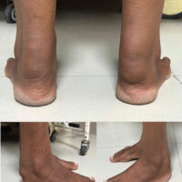 Figure 1: Clinical photograph of both ankles showing fusiform swelling over the posterior aspect of the ankles.