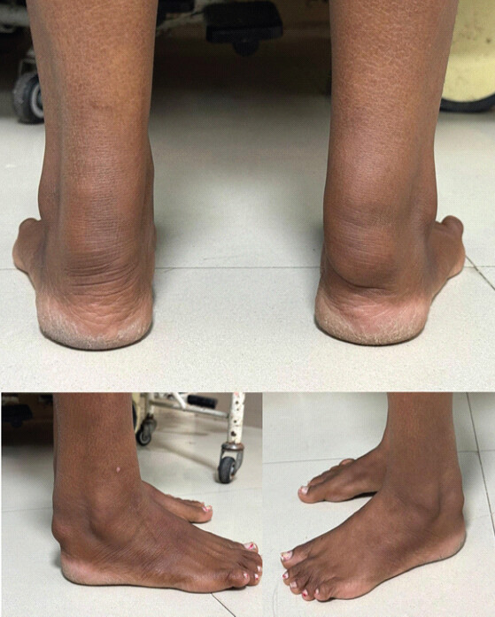 Figure 1: Clinical photograph of both ankles showing fusiform swelling over the posterior aspect of the ankles.