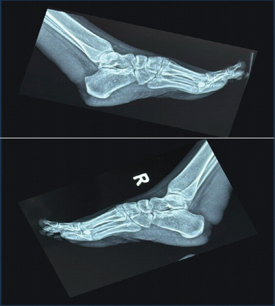 Figure 2: Lateral radiograph of both ankles showing normal bony anatomy and a distinct soft-tissue shadow over the posterior aspect of both ankles.