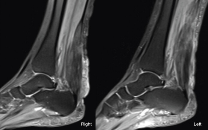 Figure3: T2-weighted, fat-suppressed sagittal magnetic resonance imaging of both ankles showing symmetrical fusiform thickening of the Achilles tendons with heterogeneous increased intratendinous signal intensity and loss of the normal anterior concavity.