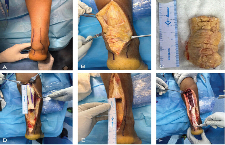 Figure 4: Intraoperative images. (a) Skin marking. (b) Central midline incision over the swelling. (c) Gross appearance of the resected xanthoma. (d and e) Marking of the turn-down flap and the tendon gap after resection. (f) Bridging of the gap with the gastrosoleus turn-down flap.