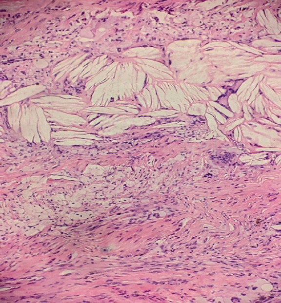 Figure 5: Photomicrograph (hematoxylin and eosin, ×20) showing dense collagenous tendon tissue infiltrated by sheets of foamy histiocytes with abundant vacuolated cytoplasm. Numerous cholesterol clefts are surrounded by foreign body-type multinucleated giant cells and focal chronic inflammatory infiltrates.