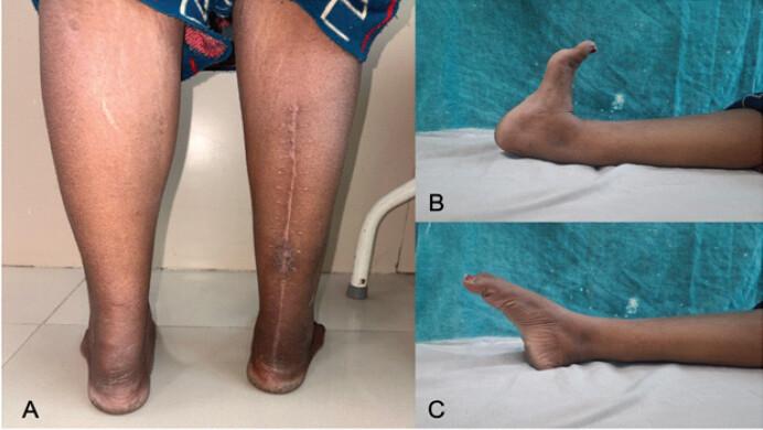 Figure 6: Clinical photographs at 1-year follow-up showing the healed scar (a), ankle dorsiflexion (b), and plantarflexion (c).