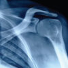 Proximal Humerus Ewing Sarcoma: Technical Challenges and Strategies for Bone Defect Reconstruction