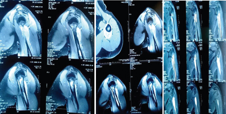 Figure 2: Pre-operative magnetic resonance imaging of the left shoulder showing an aggressive soft tissue mass arising from the proximal humerus, measuring 4 × 2 cm, with cortical breakthrough and focal soft-tissue invasion of the triceps long head. No involvement of the deltoid muscle, rotator cuff, glenoid, or neurovascular bundle is noted.