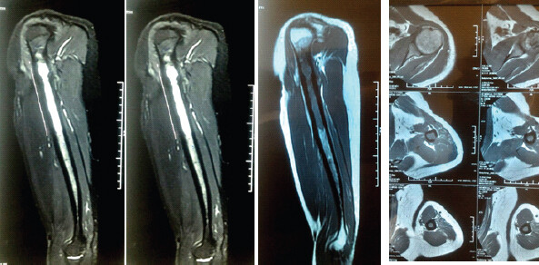 Figure 3: Post-neoadjuvant chemotherapy magnetic resonance imaging demonstrating complete regression of the soft tissue extension with no residual extraosseous tumor mass.