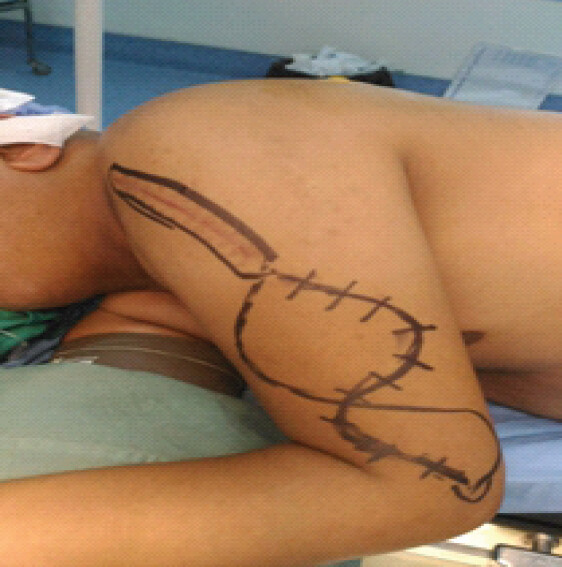 Figure 4: Intraoperative photograph showing patient positioning and surgical skin markings.