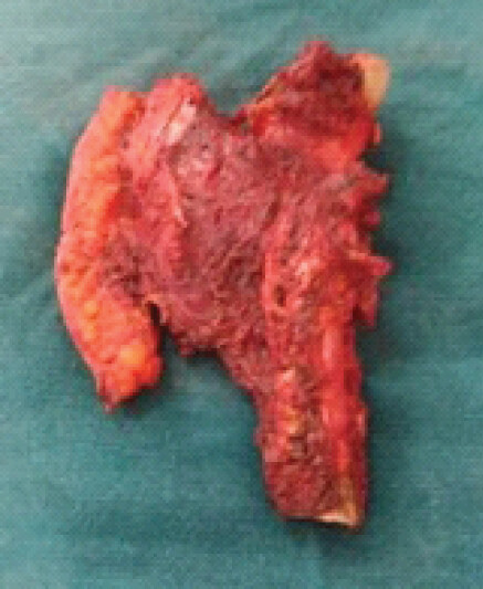 Figure 5: Gross pathological specimen following diaphyso-metaphyseal tumor resection, demonstrating en-bloc removal of the proximal humeral segment.