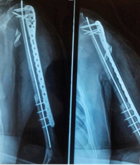 Figure 6: Immediate post-operative anteroposterior radiograph of the left shoulder showing the non-vascularized fibular autograft stabilized with an anatomical locking plate and an intramedullary pin.