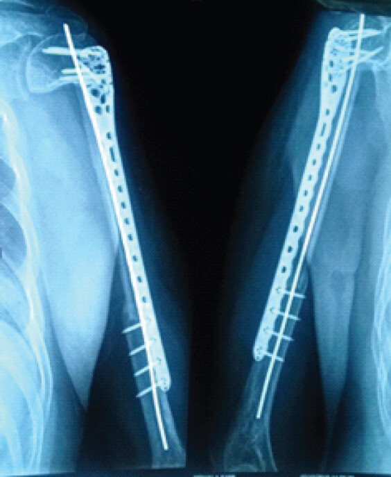 Figure 7: Anteroposterior radiograph of the left shoulder at 30-month follow-up demonstrating good graft integration with no evidence of local tumor recurrence or hardware failure.
