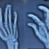 Measured Flap Planning for Adult Complex Syndactyly Release: A Technical Case Report