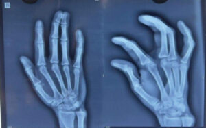 Figure 1: Pre-operative X-ray showing complex syndactyly.