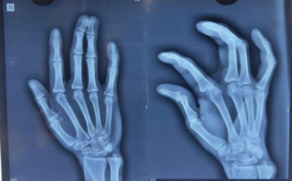 Figure 1: Pre-operative X-ray showing complex syndactyly.