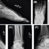 Successful Limb Salvage Using Staged Applications of a Fish-Skin Xenograft (Kerecis) in a Heel Pad Degloving Injury: A Case Report