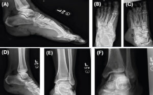 Figure 1: (a-f) Initial radiographs of the left ankle and foot following the accident.