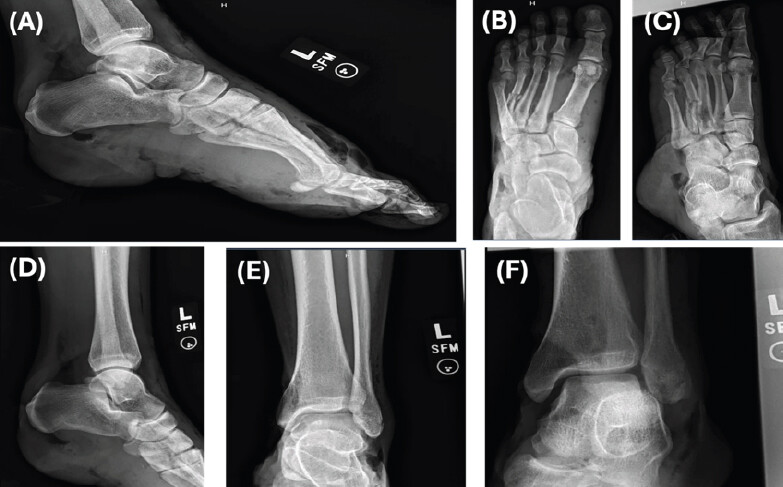 Figure 1: (a-f) Initial radiographs of the left ankle and foot following the accident.