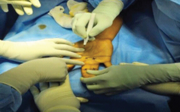 Figure 2: Marking the metacarpophalangeal and proximal interphalangeal joints.