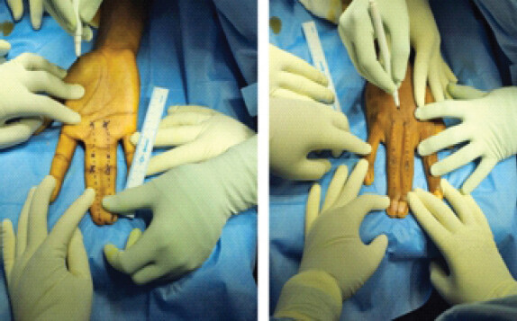 Figure 3: Images showing the mid-dorsal axis in the volar and the dorsal aspects of hand.