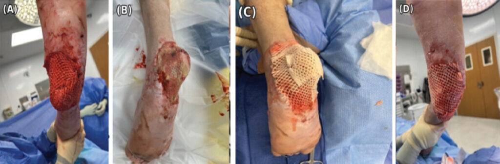 Figure 3: Staged applications of fish-skin acellular dermal matrix (Kerecis) to the heel pad defect. (a) Post-injury day 39, immediately following the first xenograft application, the wound bed measured 22 × 15 × 0.5 cm and extended to the level of the calcaneus, with the xenograft secured by staples and overlying non-adherent dressing. (b) Post-injury day 44, wound bed prior to the second xenograft application following debridement of residual non-viable tissue. (c) Post-injury day 44, immediately following the second xenograft application. (d) Post-injury day 79, immediately following the third xenograft application, the wound had been remodeled to 24 × 14 × 0.5 cm and was reconstructed with a 7 × 20 cm Kerecis sheet.