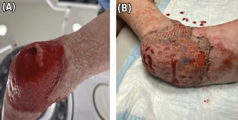 Figure 4: Wound bed preparation and definitive grafting. (a) Post-injury day 98, a well-vascularized granulation tissue bed across the heel and adjacent soft-tissue defect immediately before skin grafting. (b) Post-injury day 106, appearance immediately following full-thickness skin graft to the heel and split-thickness skin grafts to the anterior ankle and lateral heel, with good early graft take and no clinical evidence of infection.