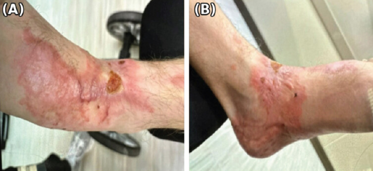 Figure 5: Long-term outcome at 3 months following definitive grafting (post-injury day 190). (a) Anterolateral view of the left foot and ankle demonstrating graft incorporation and surrounding skin maturation. (b) Posterior view of the heel and Achilles region showing healed graft sites without erythema, drainage, or breakdown.
