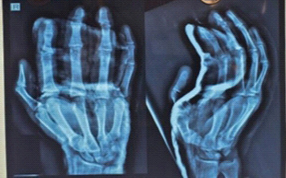 Figure 6: Post-operative x-ray showing separated digits without any bony connections.