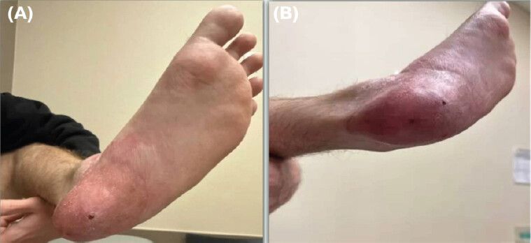 Figure 6: One-year post-operative outcome following staged fish-skin xenograft reconstruction and definitive skin grafting. (a) Plantar view demonstrating durable soft-tissue coverage of the reconstructed heel without recurrent ulceration, wound breakdown, or infection. (b) Posterior view demonstrating stable graft incorporation, contour restoration, complete epithelialization of the plantar heel, and durable reconstruction capable of tolerating full weight-bearing.
