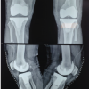Massive Hemorrhagic Blisters following Bilateral Total Knee Replacement: A Case Report