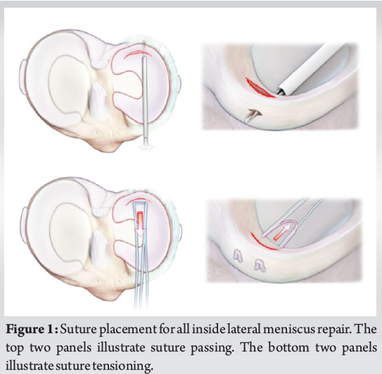 Lateral Meniscal Tears Can be Safely Repaired “All-Inside” Without ...