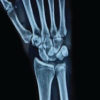 Neglected Isolated Lunate Dislocation in a Polytrauma Patient Presenting as Acute Carpal Tunnel Syndrome – A Case Report with Review of Literature