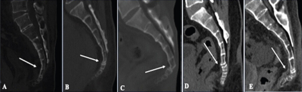 Figure 1: The type of coccyx on a sagittal computed tomography (CT) scan. (a) Type I coccyx: The coccyx is slightly curved downward (arrow). (b) Type II coccyx: The coccyx has a marked curve with the apex pointing forward (arrow). (c) Type III coccyx: The coccyx is angled forward sharply between the first and second or second and third segments (arrow). (d) Type IV coccyx: Anteriorly subluxated at the level of the sacrococcygeal joint or first or second intercoccygeal joint of the coccyx (arrow). (e) Type V coccyx: Coccygeal retroversion (arrow).