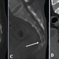 Figure 1: The type of coccyx on a sagittal computed tomography (CT) scan. (a) Type I coccyx: The coccyx is slightly curved downward (arrow). (b) Type II coccyx: The coccyx has a marked curve with the apex pointing forward (arrow). (c) Type III coccyx: The coccyx is angled forward sharply between the first and second or second and third segments (arrow). (d) Type IV coccyx: Anteriorly subluxated at the level of the sacrococcygeal joint or first or second intercoccygeal joint of the coccyx (arrow). (e) Type V coccyx: Coccygeal retroversion (arrow).