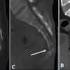 Morphometric Variants of the Coccyx in an Eastern Indian Cohort: Analysis from a Tertiary Care Center