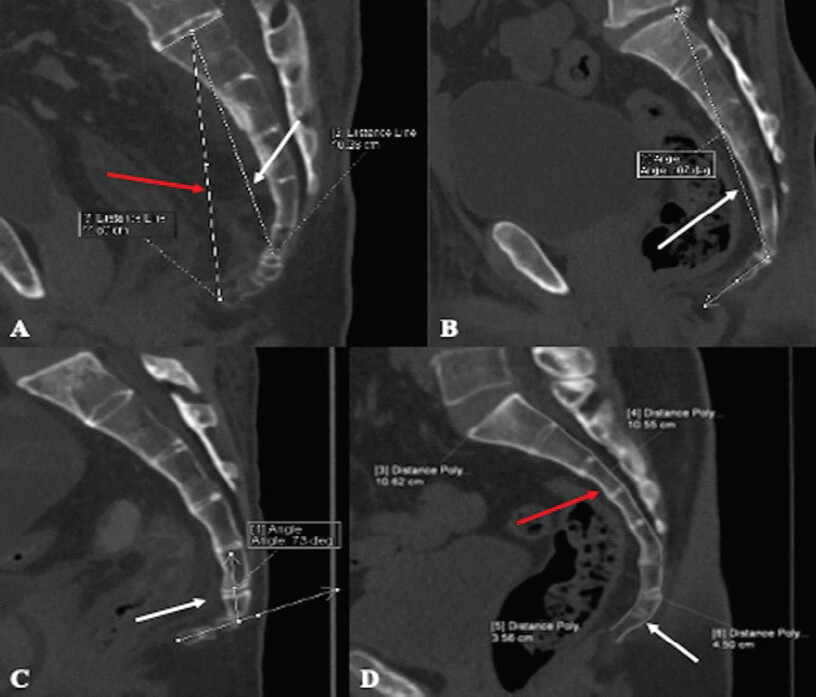 Figure 2: Different measurements of a sagittal computed tomography (CT) scan. (A) STRAIGHT Sacral length: A straight line joining the midpoint of the upper border of S1 to the midpoint of the inferior border of S5, distance line 2 in Figure 2a (white arrow); Straight Sacrococcygeal length: A straight line joining the midpoint of the upper border of S1 to the tip of the coccyx, distance line 3 in Figure 2a (red arrow). (b) Sacrococcygeal angle: Angle between the line joining the midpoint of the upper border of S1–1st coccyx and the line between the 1st and last coccyx segment (white arrow). (c) Showed the intercoccygeal angle: Angle between the line drawn parallel to the long axis of the 1st coccyx segment and the line parallel to the long axis of the last coccyx segment in midsagittal position (white arrow). (d) Showed coccygeal curved length: Mean of the anterior and posterior curved coccygeal lengths measured from the upper border of the 1st coccyx segment to the tip of the coccyx (white arrow) and Sacral curved length: Mean of the anterior and posterior curved sacral lengths measured from the upper border of S1 to the inferior border of S5 (red arrow).