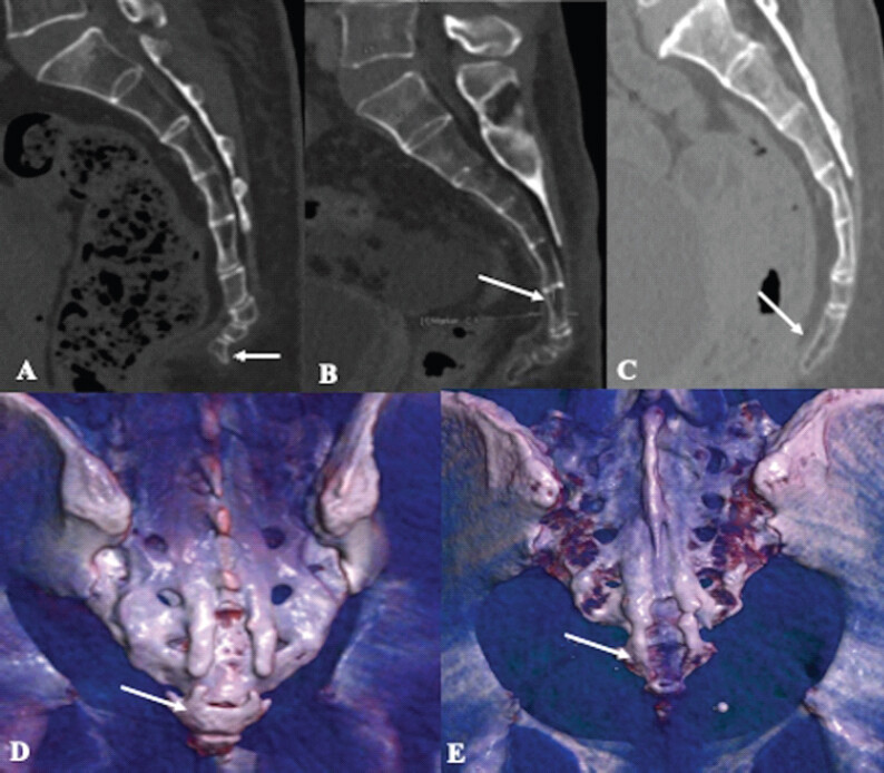 Figure 3: The morphologic variations in the coccyx on computed tomography (CT) scan and volume rendered technique (VRT) images of a sagittal NCCT image. (a) Coccygeal spicule: A bone spicule projecting from the terminal coccygeal segment (white arrow). (b) Sacrococcygeal joint fusion (white arrow). (c) Intercoccygeal joint fusion (white arrow). VRT images. (d) Bilateral sacralization of coccyx (white arrow) and (e) bilateral partial sacralization of the coccyx (white arrow).