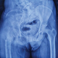Figure 1: Radiograph of bilateral hip with pelvis of patient at presentation preoperatively showing a lytic lesion at right proximal femur with fracture neck of femur.